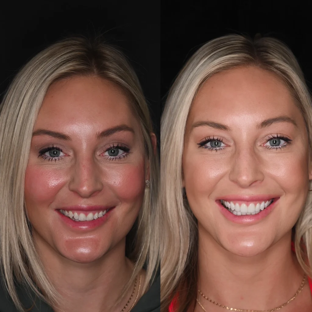 Before and after a smile makeover in Tennessee at East Nashville Aesthetic and Implant Dentistry by Dr. Skylor Morton