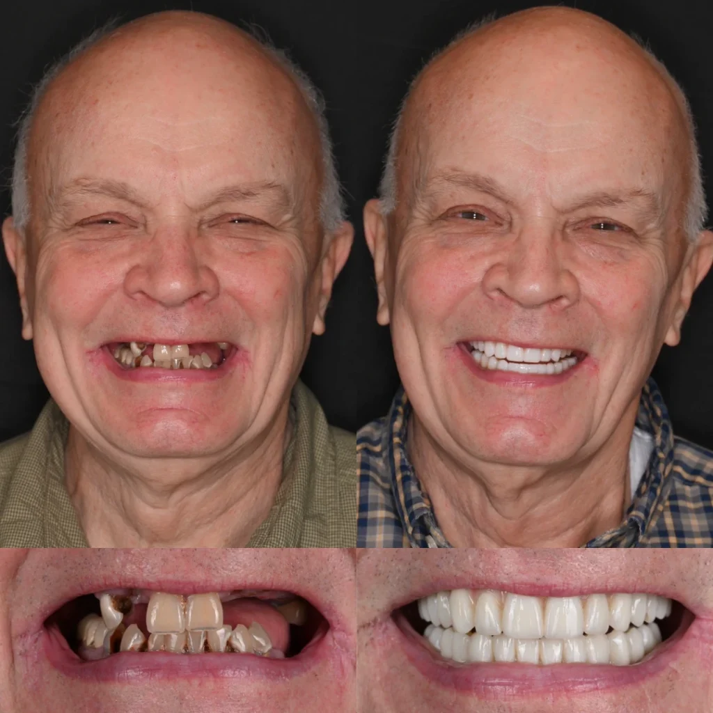 Before and after dental implants in Nashville, TN at East Nashville Aesthetic and Implant Dentistry