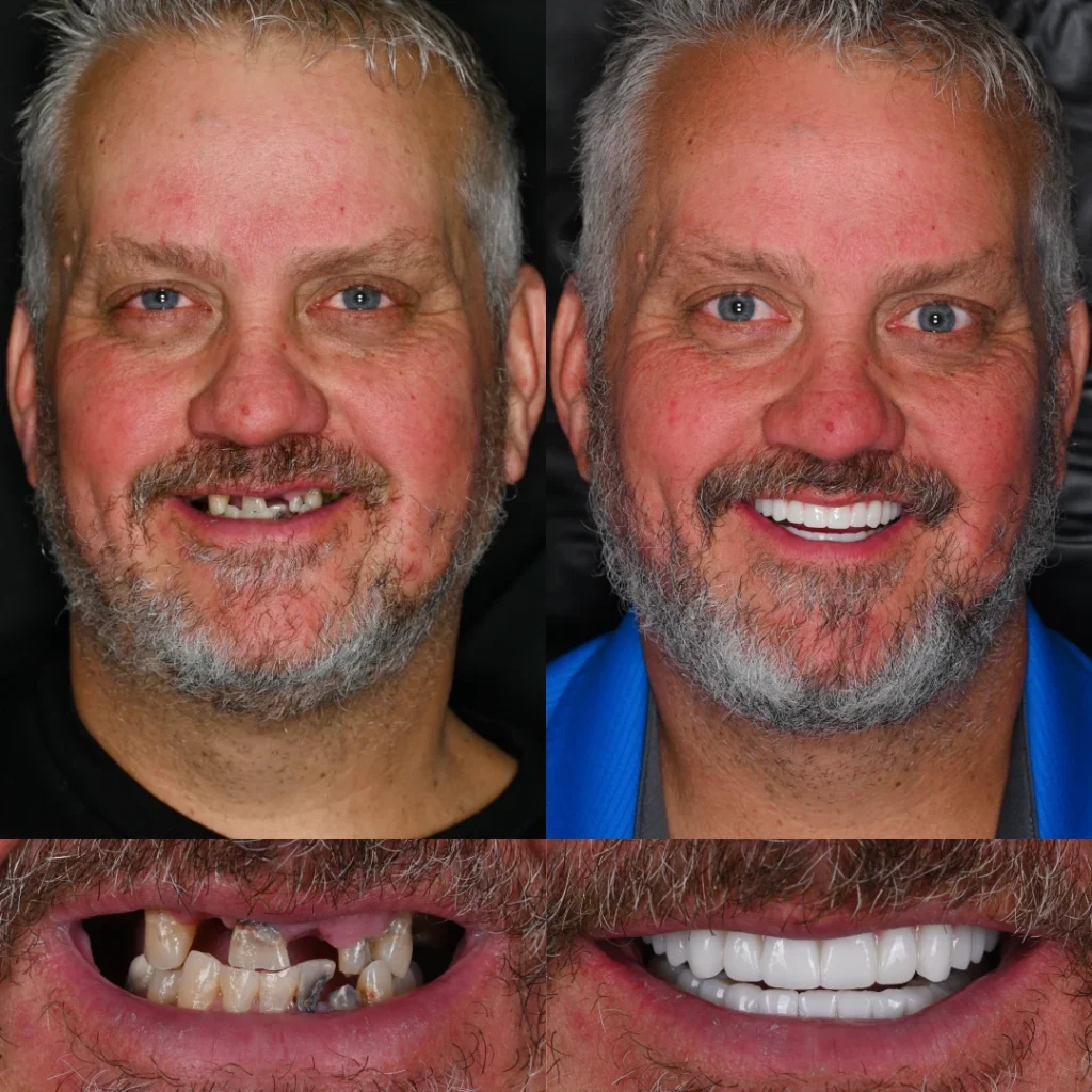 Before and after dental implants in Nashville, TN at East Nashville Aesthetic and Implant Dentistry