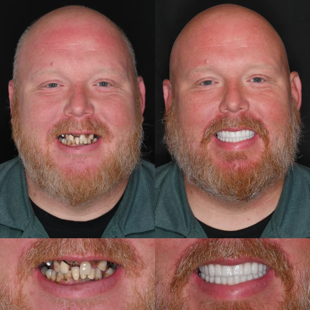 Before and after dental implants in Nashville, TN at East Nashville Aesthetic and Implant Dentistry