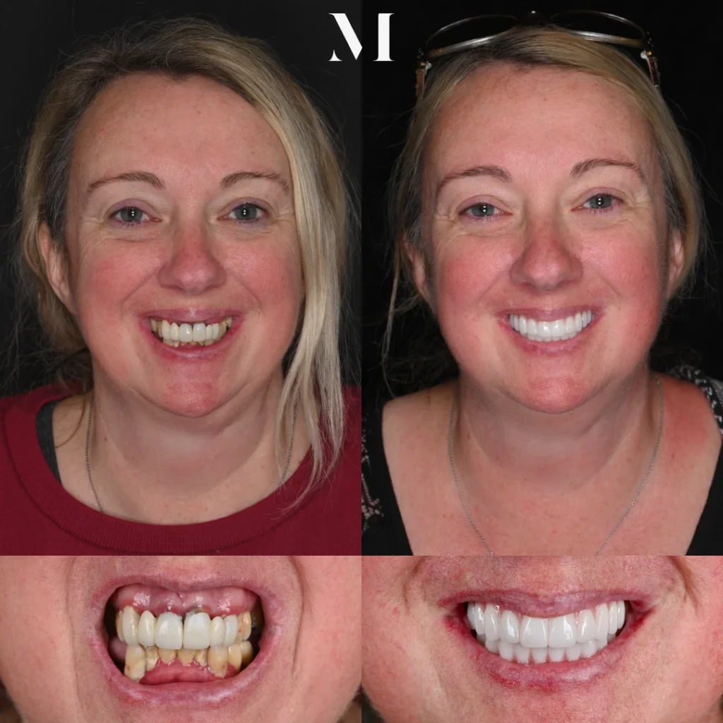 Before and after dental implants in Nashville, TN at East Nashville Aesthetic and Implant Dentistry